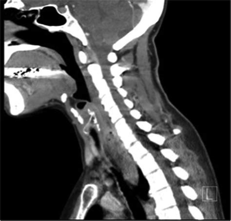 Endoscopic resection of a giant fibrovascular polyp of the oesophagus with the assistance of ...