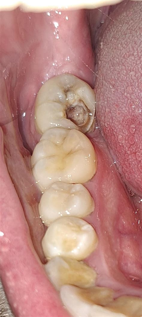 Image result for Back Molar Tooth Extraction