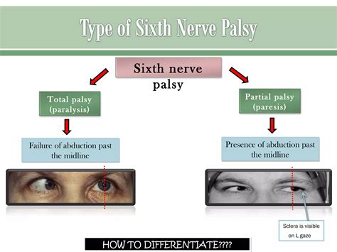 Cranial Nerve Palsies