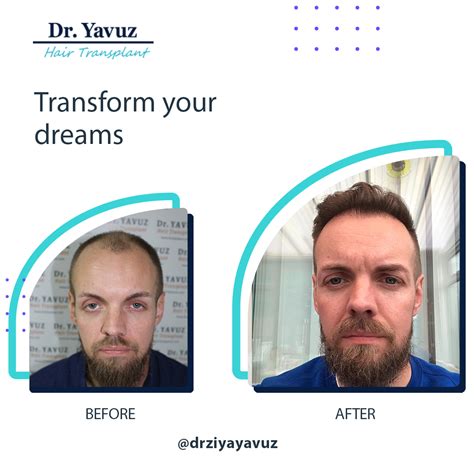 Before After | Dr. Ziya Yavuz