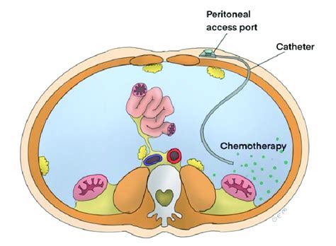 Image result for Intraperitoneal Therapy