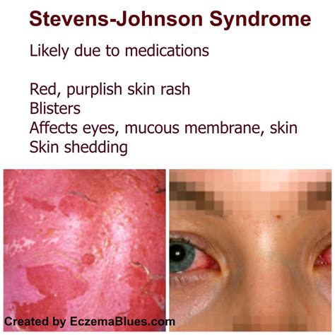 Life Threatening Skin Rash series – Stevens Johnson Syndrome - Eczema Blues