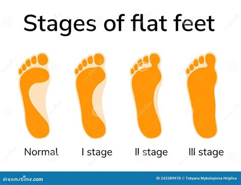 Stages of flat feet stock vector. Illustration of human - 243389978