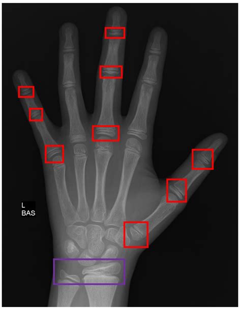 X Ray Hand