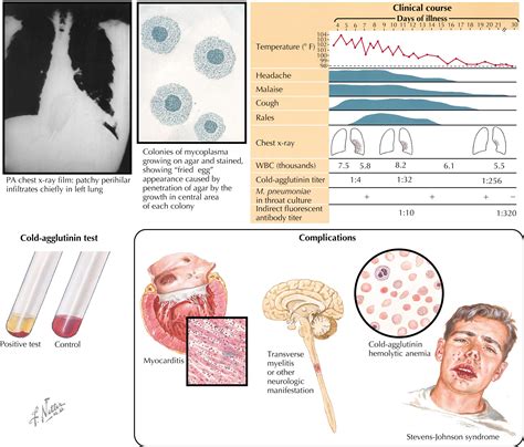 Atypical Pneumonia - Clinical Tree