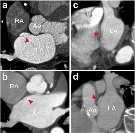 Left atrial accessory appendages, diverticula, and left-sided septal ...