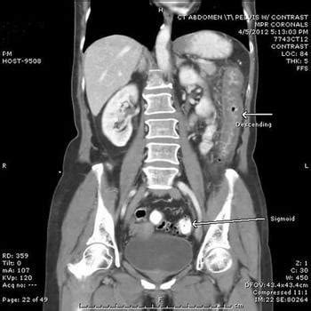 Ischemic Colitis - Ischemic Colitis - MSD Manual Professional Edition