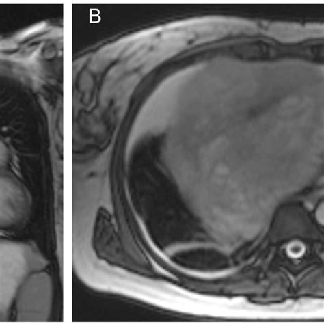 Image result for Clamshell Thoracotomy
