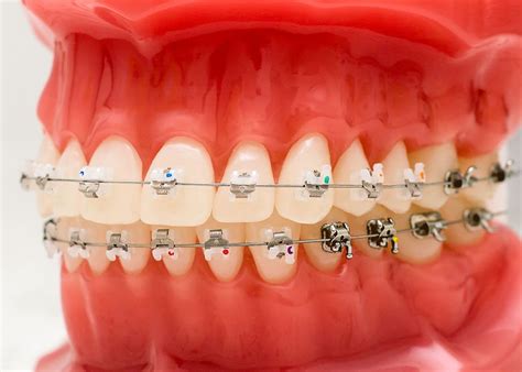 Are Adult Braces Affordable? - Philadelphia, PA - Bala Cynwyd, PA - Bensalem, PA