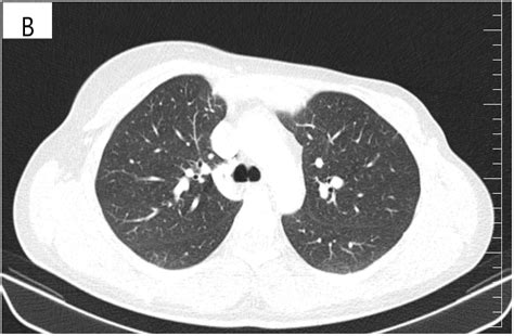 Management of HER2-Positive Breast Cancer for a Young Patient with ...