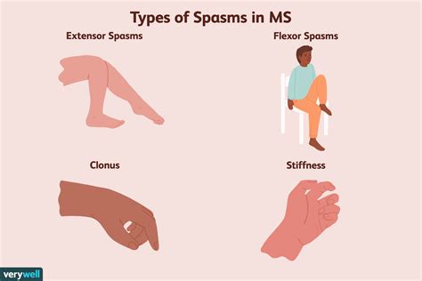 Spasticiteit als symptoom van multiple sclerose - Med NL