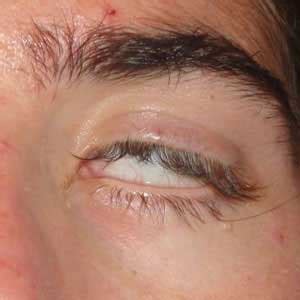 Lagophthalmos Management (Conservative And Gold Weight Implant)