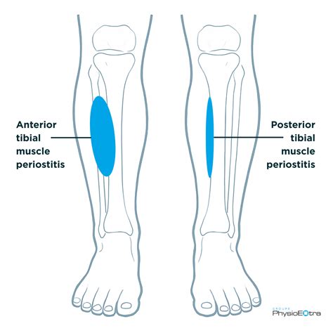 Shin Splints in Runners: Common Causes and Prevention Tips | PhysioExtra