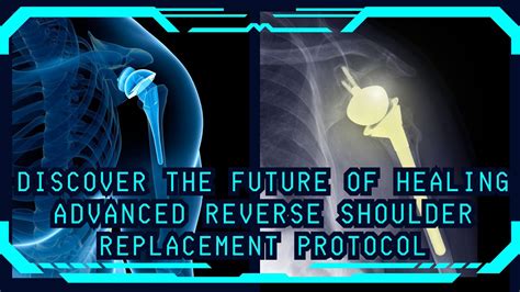 Is Reverse Shoulder Replacement An Outpatient at Paige Brown blog