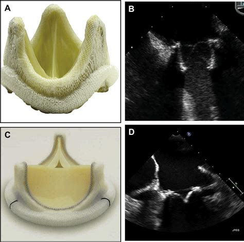 Is A Tissue Valve A Prosthetic Valve at Glenn Nelsen blog