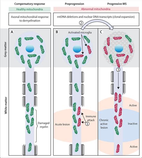 Pathological mechanisms in progressive multiple sclerosis - The Lancet Neurology