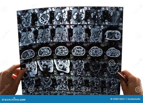 A Female Doctor Examines An MRI Scan Of The Internal Organs. Abdomen. Stock Image ...