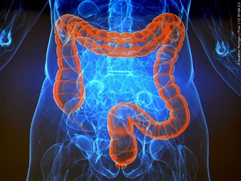 Colorectal cancer rising among younger adults, UAB doctor urges earlier ...