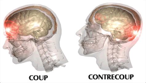 Image result for Contralateral Brain Injury