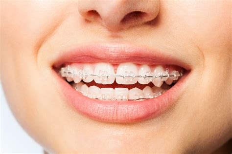 Clear Braces | Invisible Braces — Lemchen Salzer Orthodontics | Park ...