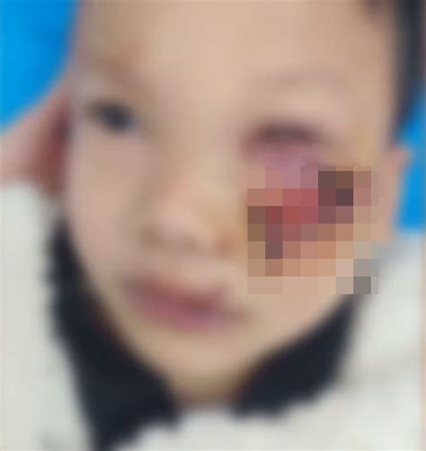 江西8岁男童遭狗咬脸缝90多针几乎毁容 母急寻狗主 | 星岛日报