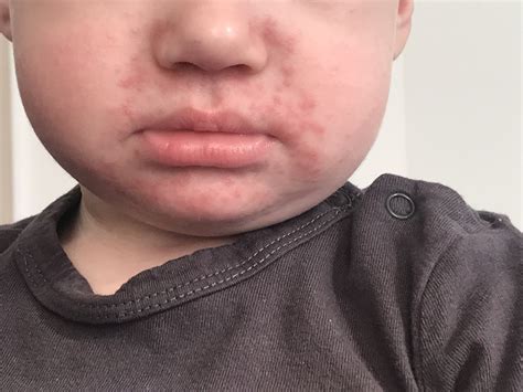 Perioral Dermatitis In Children