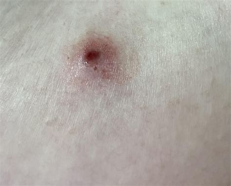 Weird bloody pimple on my chest that won’t go away : r/DermatologyQuestions