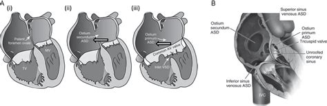 Cardiac Defects—Anatomy and Physiology - Clinical Tree