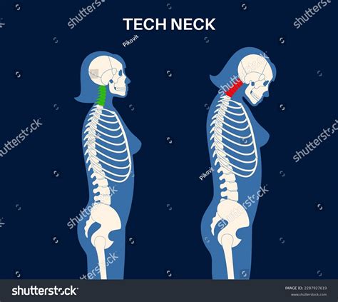 Diagram Deformation Cervical Vertebrae Neck Spasm Stock Vector (Royalty Free) 2287927619 ...