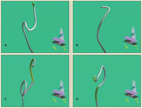 Image result for Colono Looping Colonoscopy