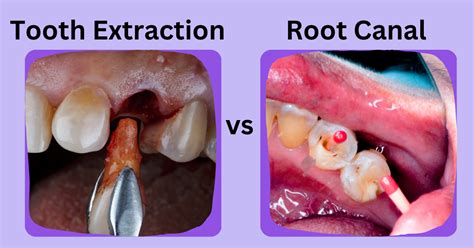 Difficult Tooth Root Extraction 的图像结果