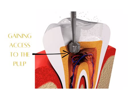 Do You Really Need a Root Canal Treatment? Symptoms, Procedure & What ...
