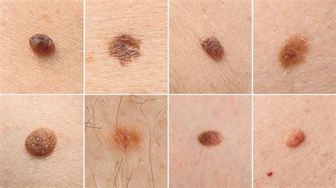 Skin Moles Types
