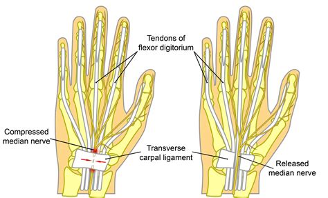 Carpel Tunnel Surgery