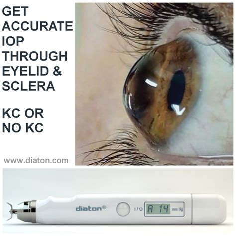 Diaton Transpalpebral Scleral Tonometer: Painless, Accurate Eye Pressure Measurement for ...