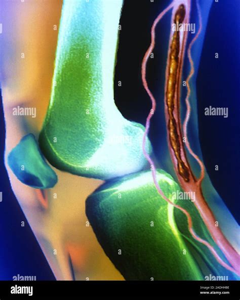 Knee thrombosis. Coloured X-ray angiogram of a thrombus (blood clot, brown, upper right) in the ...