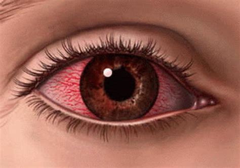 Tips Mencegah Menyembuhkan Sakit Mata / Mata Merah Dengan Cepat Dan ...