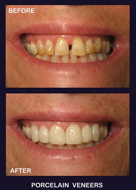 Light brown spots on teeth near gums - robomzaer