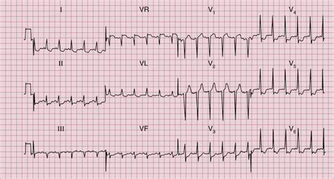 Image result for AFib Detection Algorithm