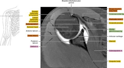 Mr Arthrogram Shoulder 的图像结果