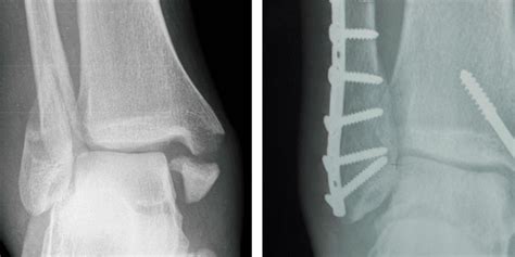 Casting versus surgery for ankle fractures in older adults | 2 Minute ...