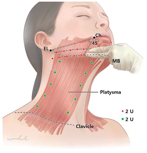 Anatomical Proposal for Botulinum Neurotoxin Injection Targeting the Platysma Muscle for ...