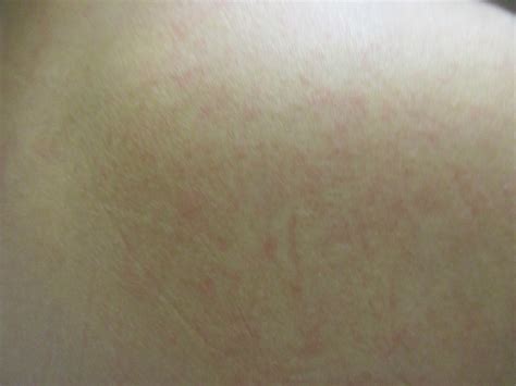 A 22 y.o. returns from Africa with a fever of 103 and a rash. She has a history of autoimmune ...
