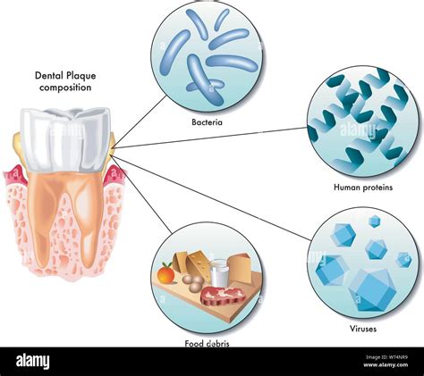 Dental Plaque Biofilm