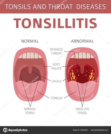 Yellow Soft Palate Sore Throat Tonsils Sore Canker V