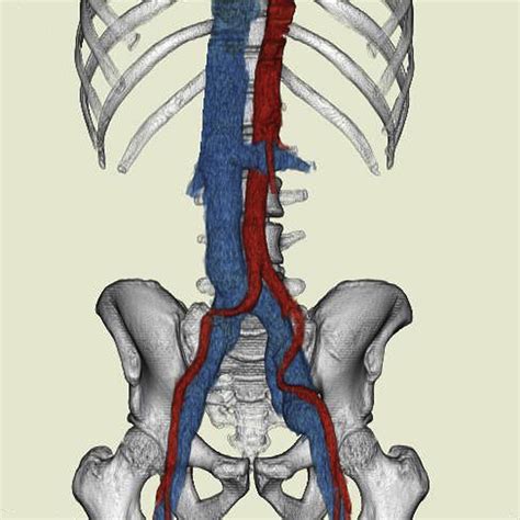 Dilation of inferior vena cava and iliac veins in elite athlete ...