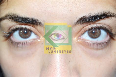 Image result for Eye Color Surgery
