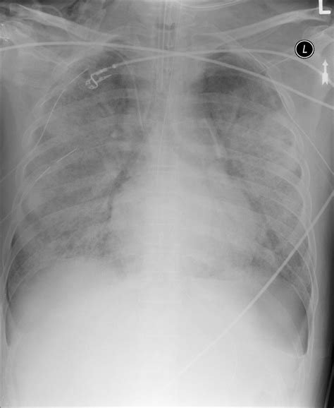 Sulcus Sign Explained 的图像结果