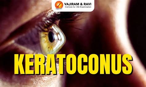 Keratoconus, Treatment, Prevention, Latest News