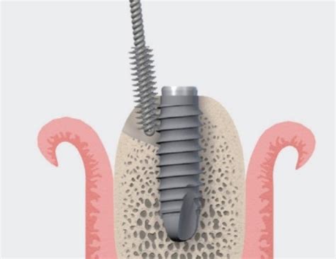 Use of titanium brushes promising for Implant Surface Decontamination ...